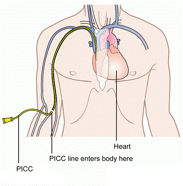 什么是PICC？为什么癌症病人要做PICC?