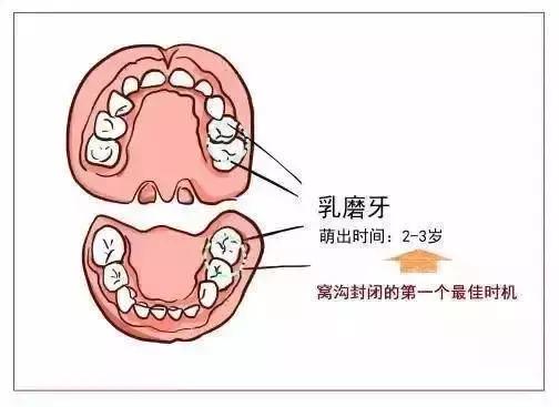 什么是窝沟封闭？为什么建议每个孩子都要做？