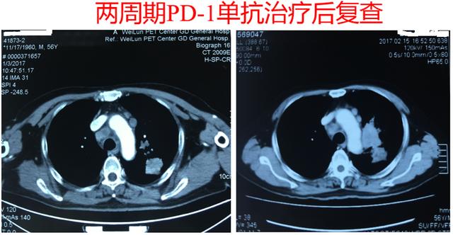 肿瘤治疗的空窗期应该如何用药？