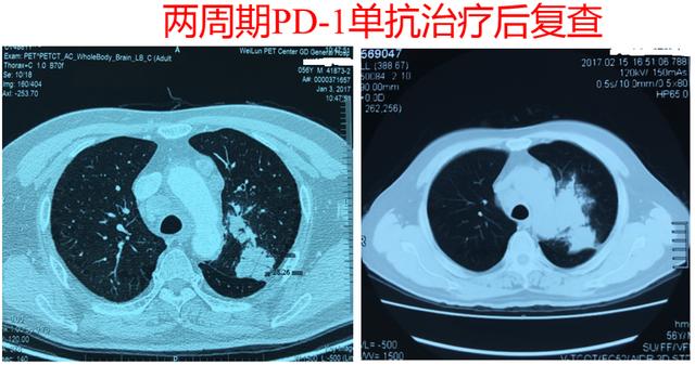 肿瘤治疗的空窗期应该如何用药？