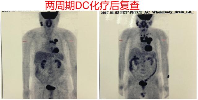 肿瘤治疗的空窗期应该如何用药？