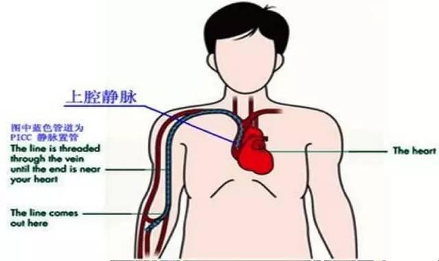 教你做一个能安心活动的PICC置管携带者