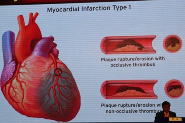 「CSC&amp;QICC2018」张运：冠状动脉非阻塞性心肌梗死诊疗进展